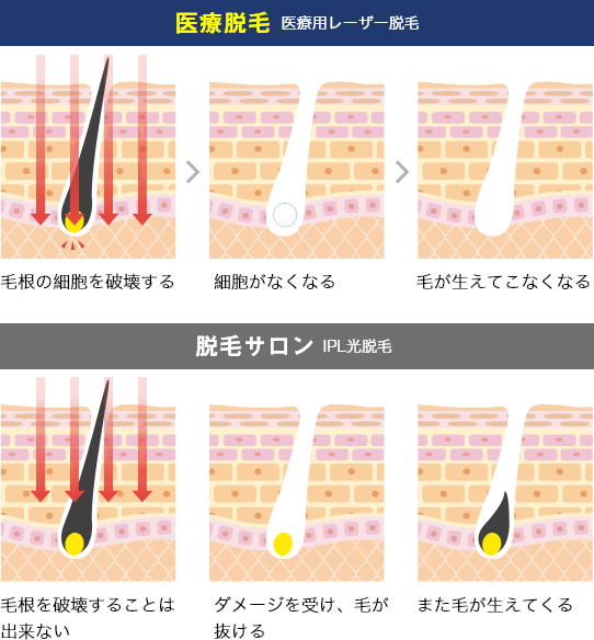 医療脱毛とサロン脱毛の違い