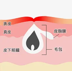 赤みが強く出るニキビ跡1