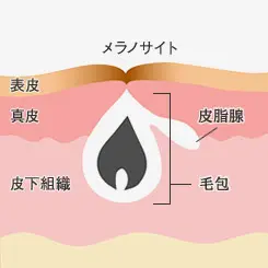 色素沈着型のニキビ跡1